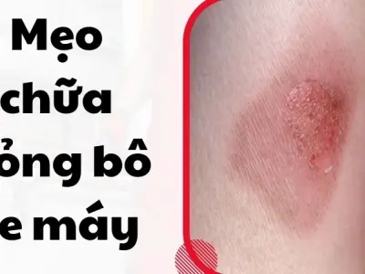 Mẹo chữa bỏng bô xe máy theo kinh nghiệm từ dân gian