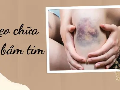 Mẹo chữa vết bầm tím giúp da phục hồi cực nhanh tại nhà