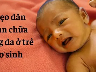 Mẹo dân gian chữa vàng da ở trẻ sơ sinh không tốn một đồng