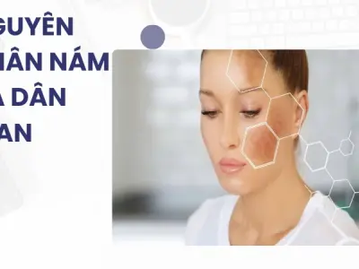 Bí quyết trị nám tại nhà hiệu quả từ mẹo dân gian truyền thống