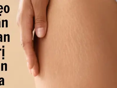 Mẹo dân gian trị rạn da cải thiện rõ chỉ sau 2 tuần