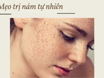 Mẹo trị nám tàn nhang tại nhà cho làn da trắng mịn không tì vết