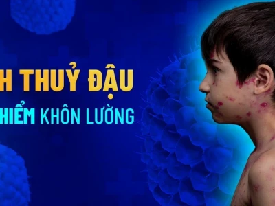 Bệnh thủy đậu là gì? Nguyên nhân, triệu chứng và cách phòng ngừa