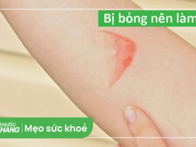 Bị bỏng bôi gì nhanh khỏi và an toàn?
