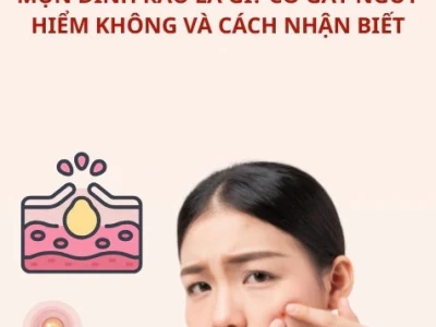 Bí quyết trị mụn đinh râu hiệu quả tại nhà và cách phòng tránh