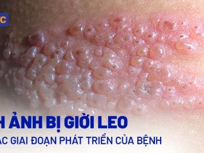 Giời Leo là Bệnh gì? Nguyên nhân, Dấu hiệu và Cách điều trị hiệu quả
