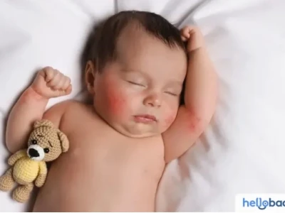 Mẹo Dân Gian Chữa Chàm Sữa Cho Trẻ Sơ Sinh: An Toàn và Hiệu Quả
